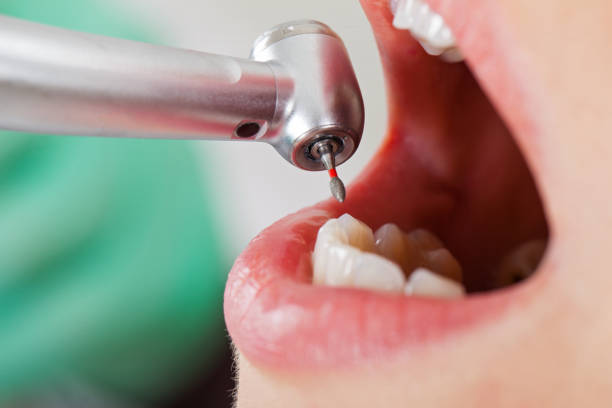 Best Emergency Treatment for Dental Infections or Abscesses in North Oaks, MN